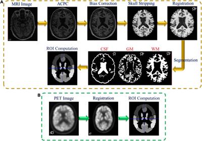 Fusing Multimodal and Anatomical Volumes of Interest Features Using Convolutional Auto-Encoder and Convolutional Neural Networks for Alzheimer’s Disease Diagnosis